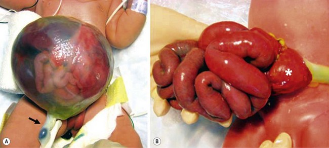 Congenital Abdominal Wall Defects | Clinical Gate