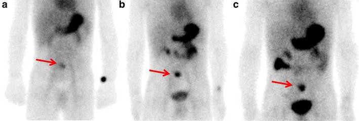 Incremental value of SPECT/CT in detection of Meckel's diverticulum in a  10-year-old child | SpringerPlus | Full Text