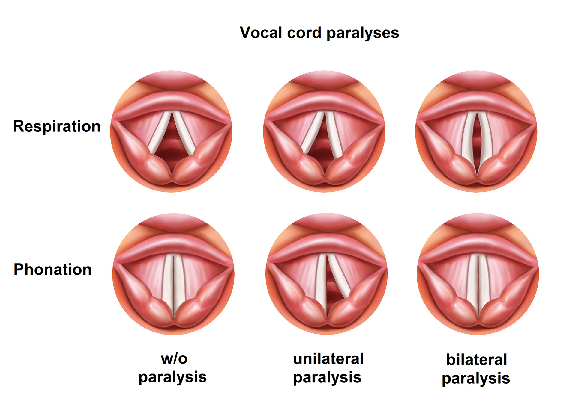 What Is Congenital Laryngeal Palsy? - StoryMD