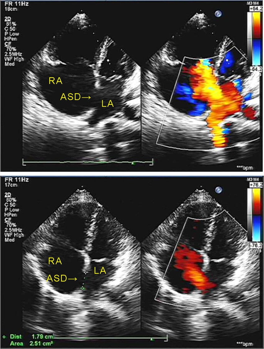 Echocardiography showed atrial septal defect. ASD, atrial septal... |  Download Scientific Diagram
