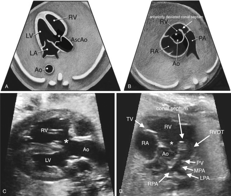 Sonographic Evaluation of the Fetal Heart | Radiology Key