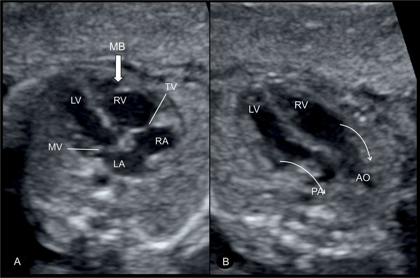 Complete and Congenitally Corrected Transposition of the Great Arteries |  Obgyn Key