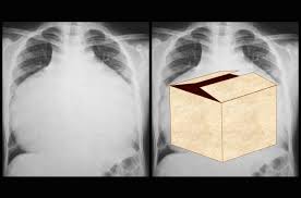 Ebstein anomaly | Radiology Reference Article | Radiopaedia.org
