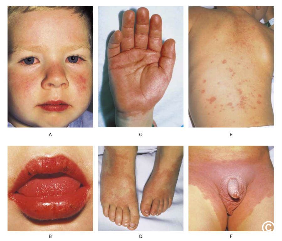 Kawasaki disease