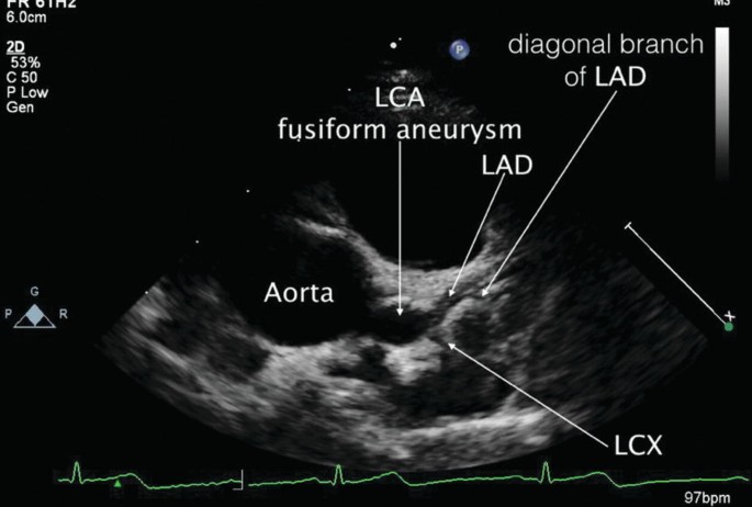 Imaging of Coronary Artery Abnormalities in Kawasaki Disease with Emphasis  on Multimodalities | SpringerLink