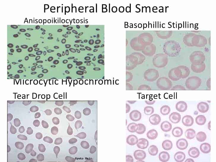 THALASSEMIA - New