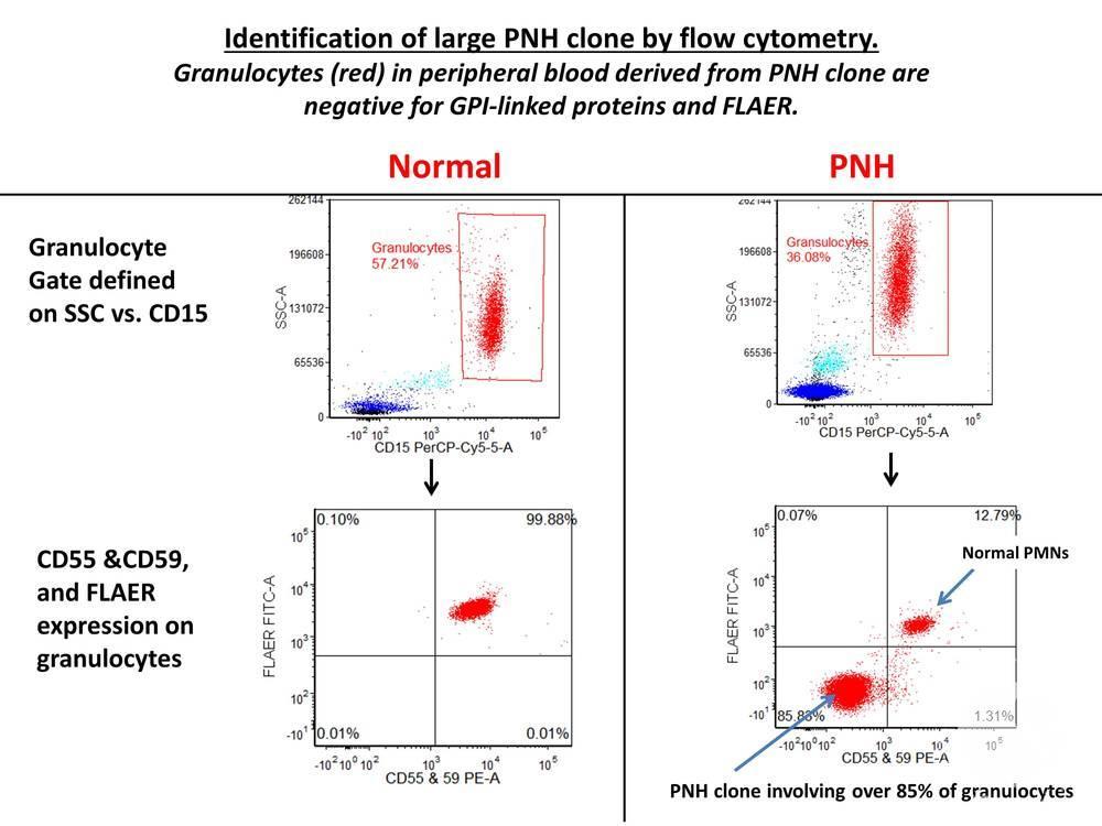 Paroxysmal nocturnal hemoglobinuria (PNH) Flow Cytometry