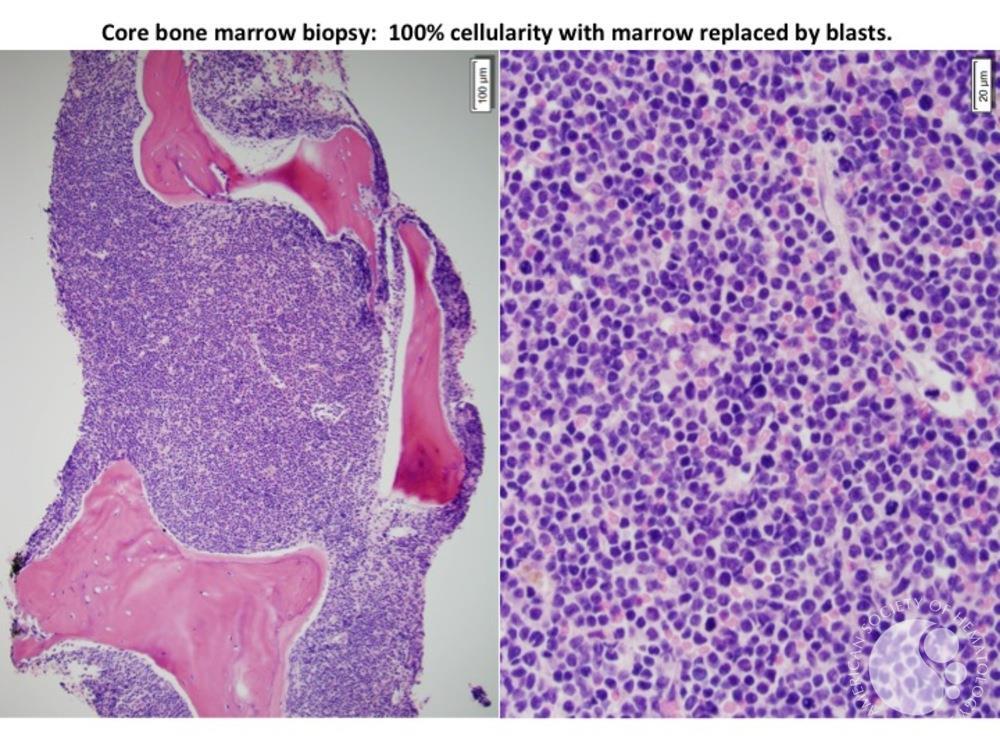 B ALL CD 34 negative Marrow biopsy
