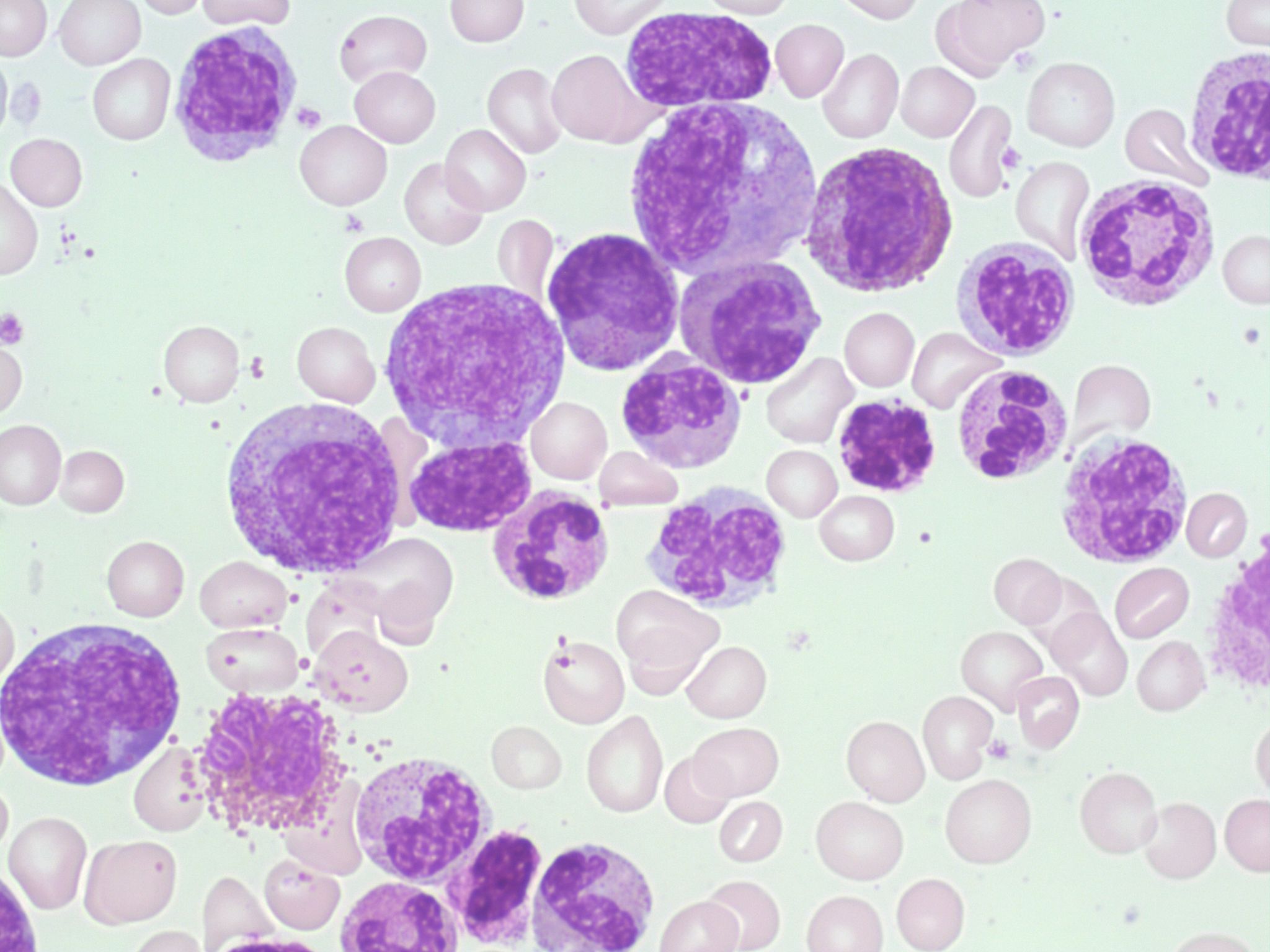 Chronic Myelogenous Leukemia (CML) – A Laboratory Guide to Clinical  Hematology