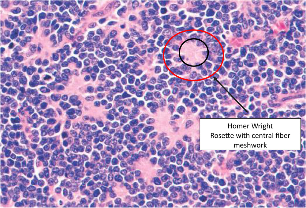 Modern surgical strategies in pediatric neuroblastoma: Evolving approaches  and treatment principles - Williams - 2025 - Pediatric Blood & Cancer -  Wiley Online Library