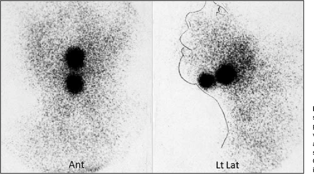 PDF] Ectopic thyroid on Scintigraphy | Semantic Scholar