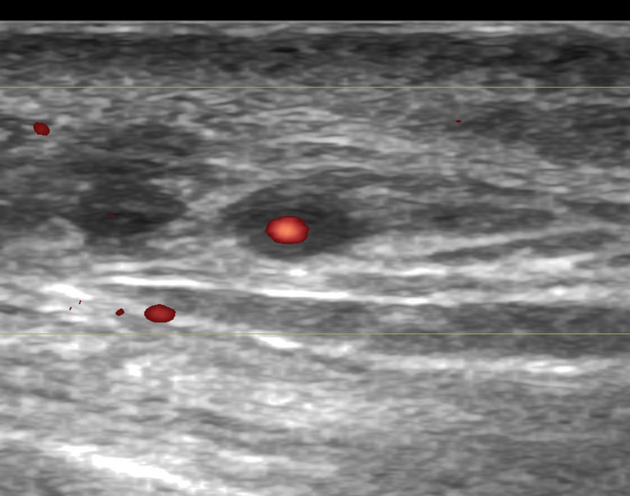 Giant cell arteritis | Radiology Case | Radiopaedia.org
