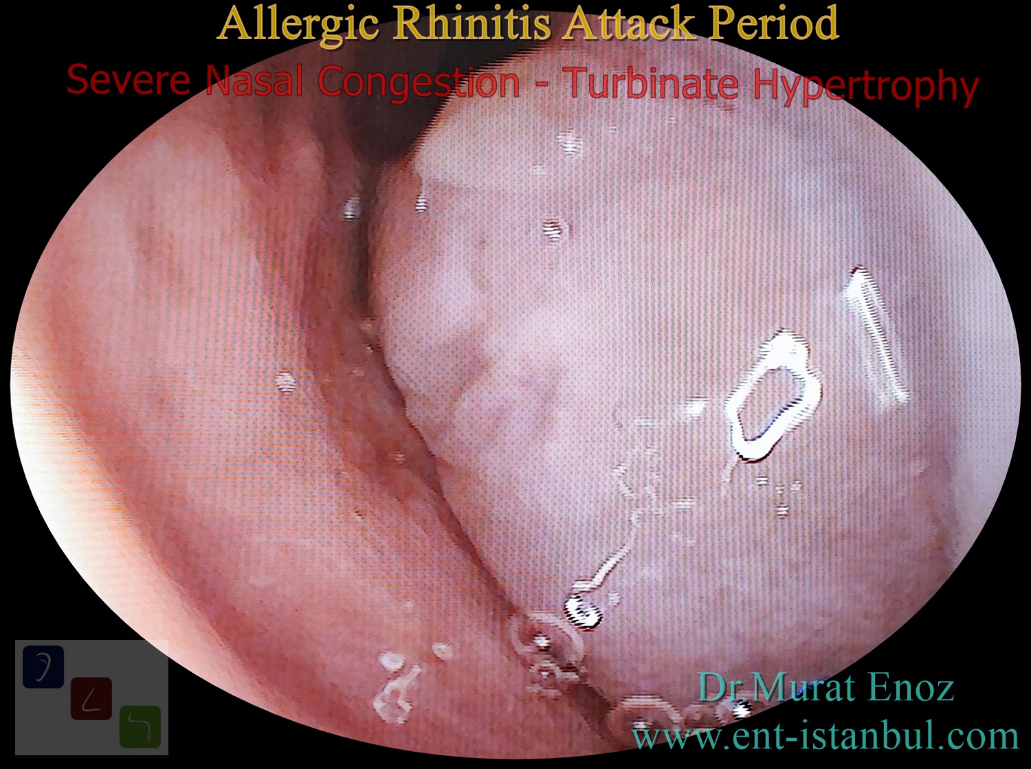 Allergic Rhinitis - Symptoms, Treatment and Precautions