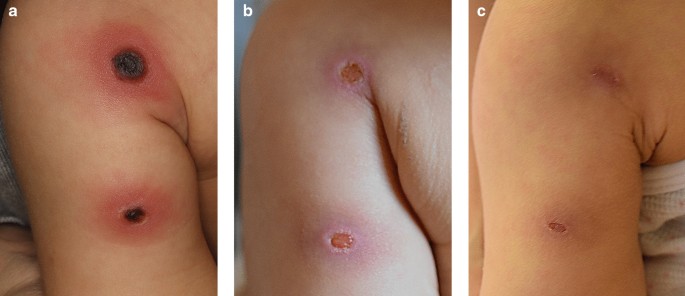 Ecthyma gangrenosum in an infant with neutropenia | International Journal  of Hematology