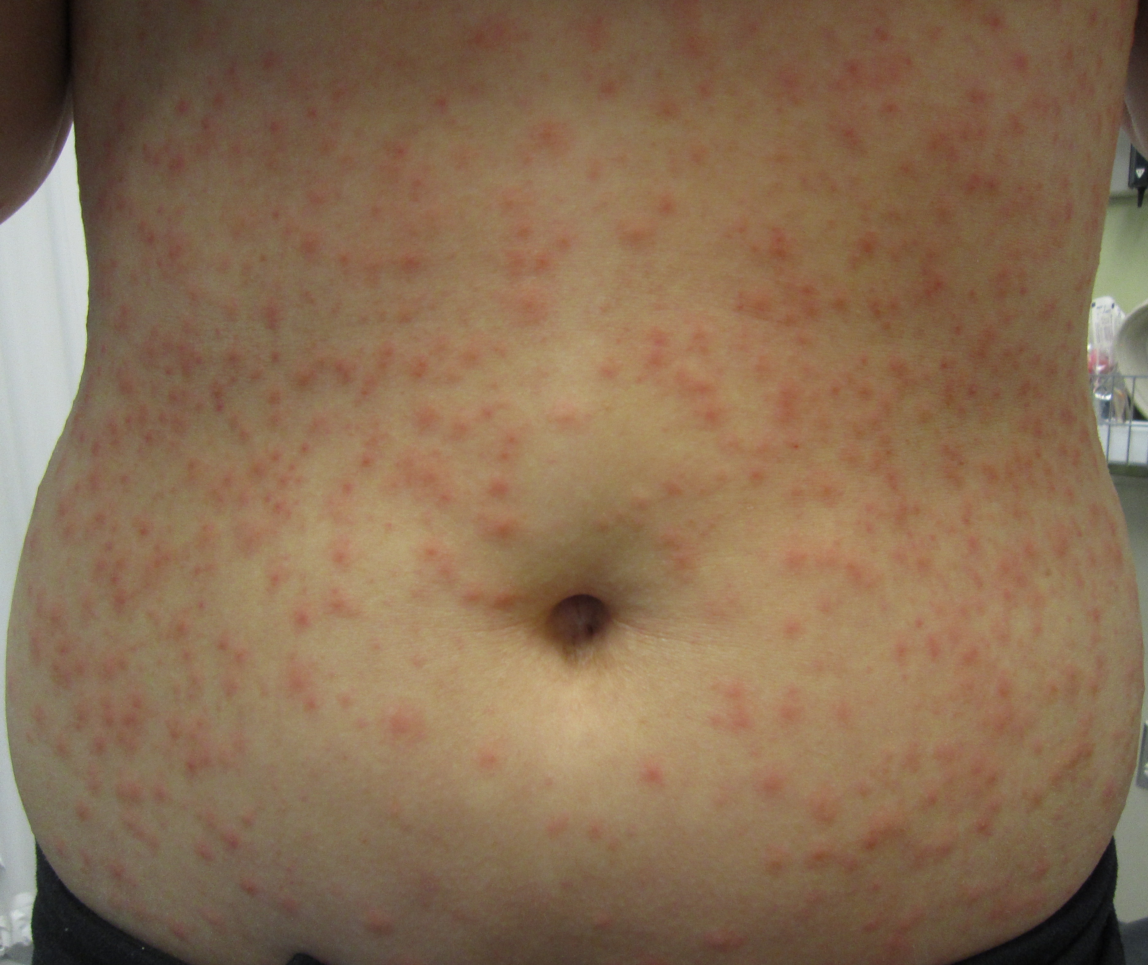 Hot tub folliculitis - Wikipedia