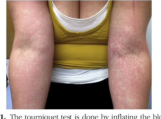 Figure 1 from Dengue with a morbilliform rash and a positive tourniquet test  | Semantic Scholar