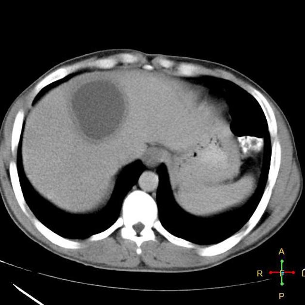 Amoebic hepatic abscess | Radiology Reference Article | Radiopaedia.org