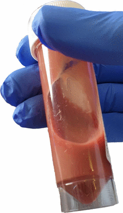 Aspiration of anchovy paste liquid from a multilobulated liver  space-occupying lesion in a patient presenting with fever and weight loss:  early stage amoebic liver abscess | BMJ Case Reports
