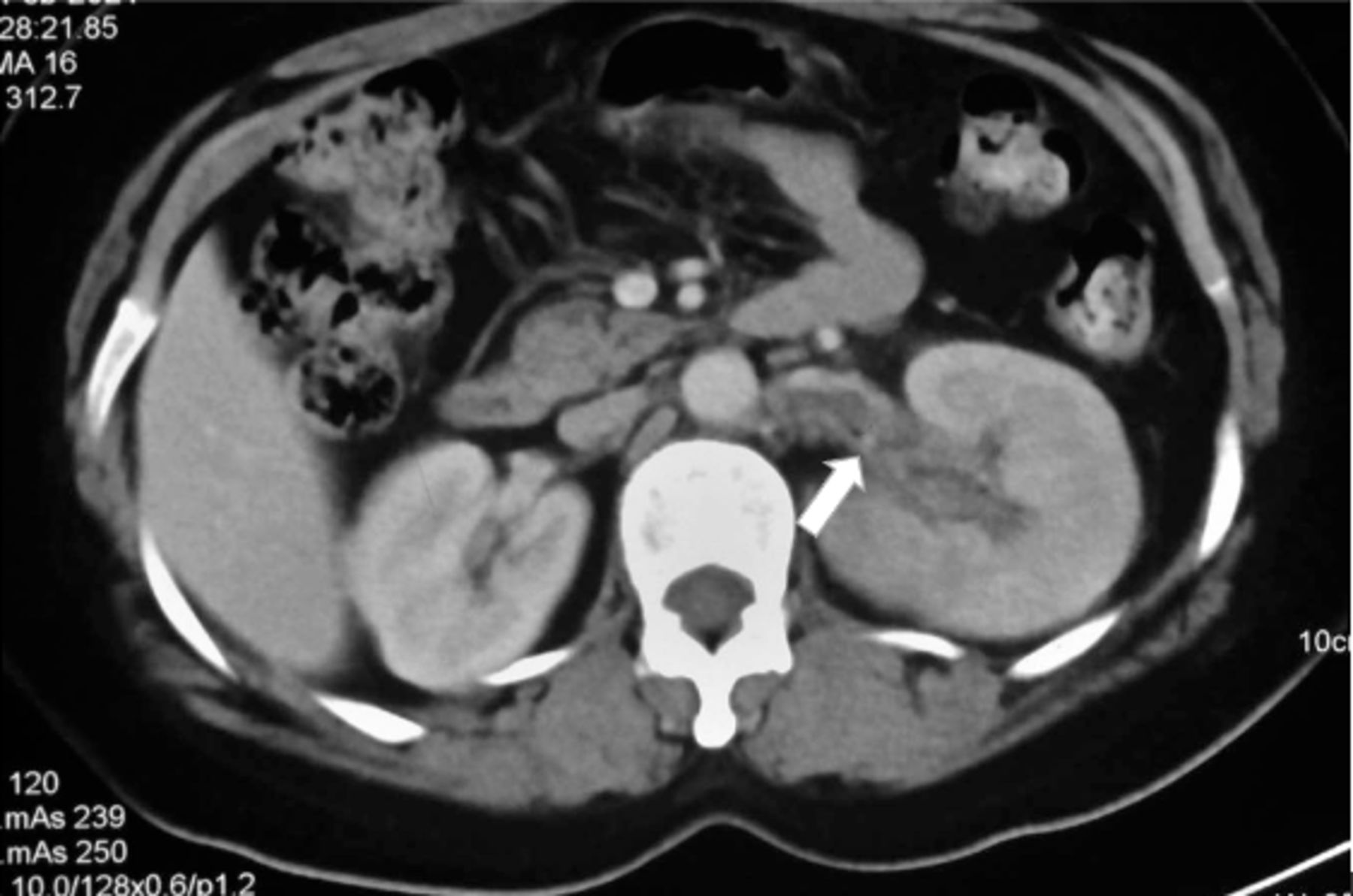 Spontaneous renal vein thrombosis: a rare cause of acute ...