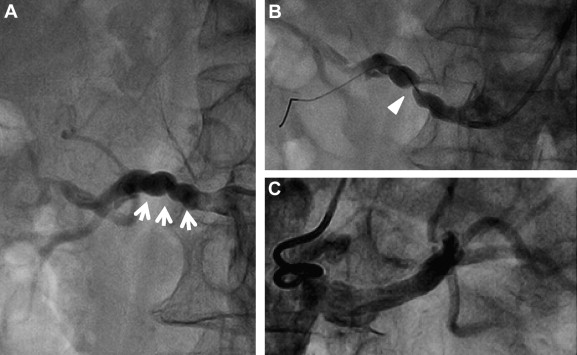 Atherosclerotic Renal Artery Stenosis Mimicking Fibromuscular Dysplasia