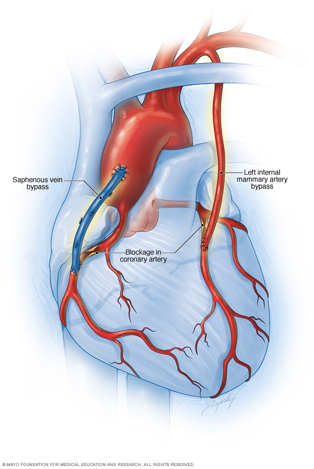 Coronary artery bypass surgery - Mayo Clinic