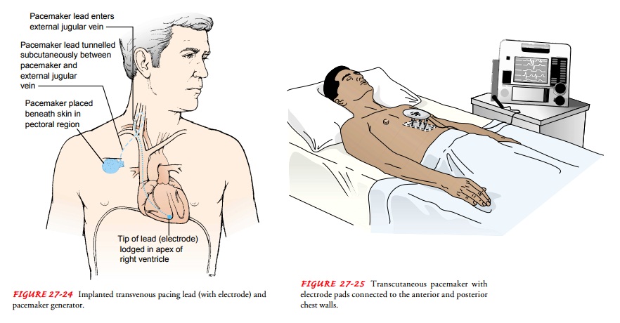 Pacemaker Therapy - Adjunctive Modalities and Management