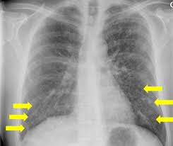 Imaging patterns of Pneumocystis jirovecii pneumonia in HIV-positive and  renal transplant patients – a multicentre study | Swiss Medical Weekly