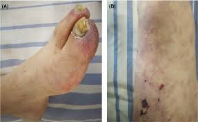 A, Blue toe syndrome; B, Livedo reticularis on the thigh skin | Download  Scientific Diagram