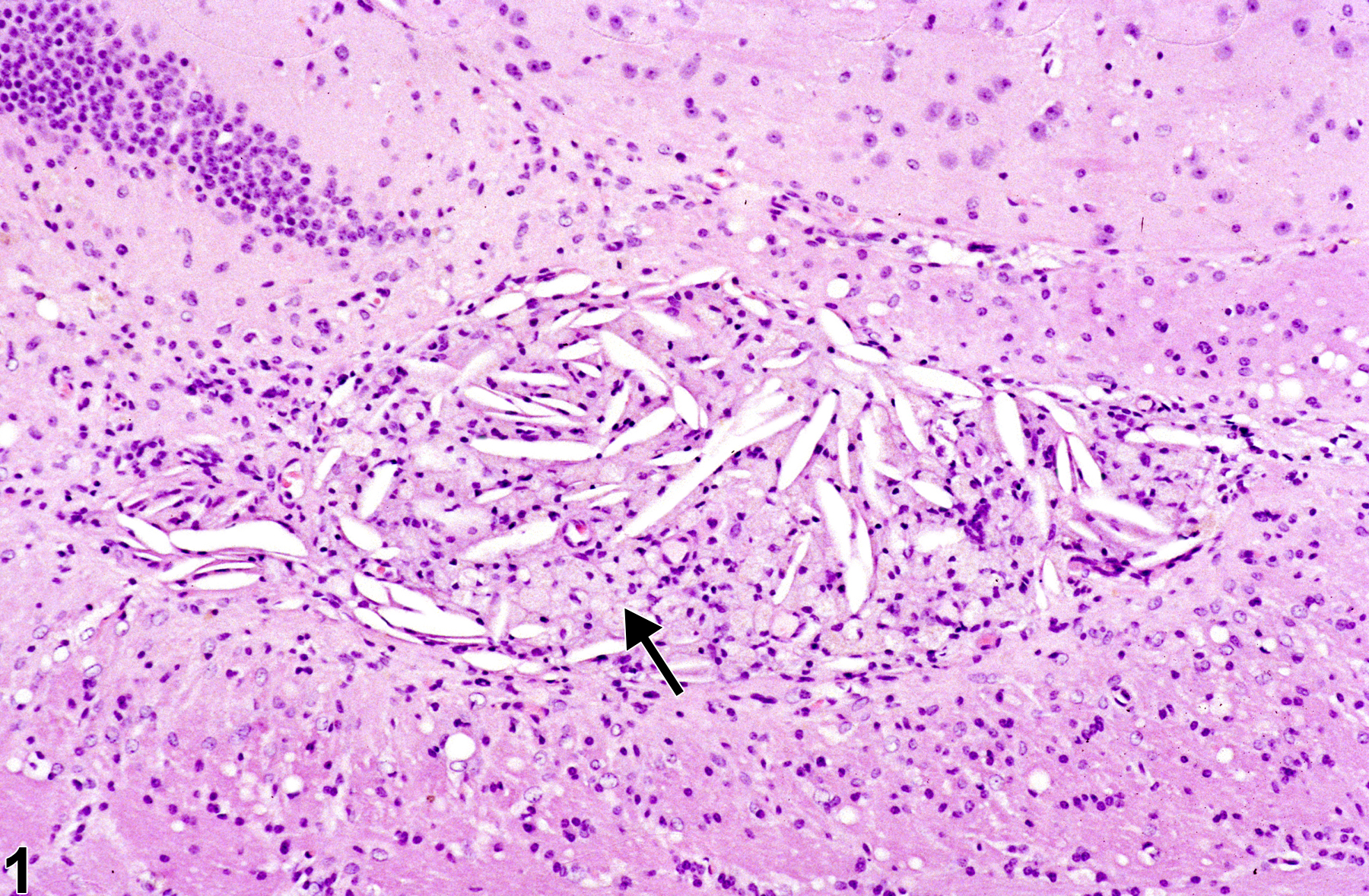 Brain - Cholesterol Clefts - Nonneoplastic Lesion Atlas