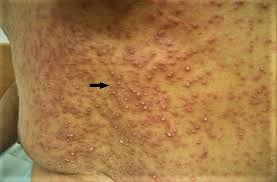 Acute Generalized Exanthematous Pustulosis Induced by Cetuximab | Cureus