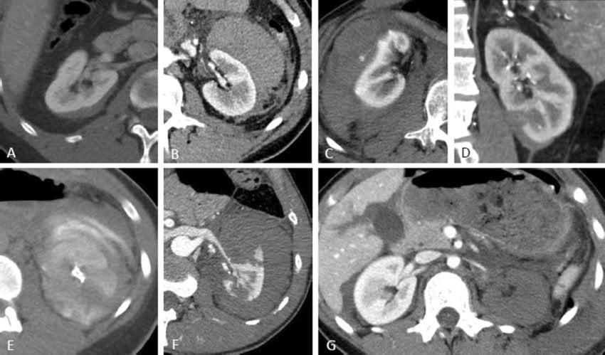 Classification of renal trauma using the American Association for the Surgery of Trauma (AAST) renal injury scale. Arterial and portal venous phase imaging is recommended for evaluation. Clinical or imaging findings suggesting collecting system injury should be followed by a delayed excretory phase to detect urine extravasation. The imaging classification criteria are as follows: grade 1 (A): subcapsular haematoma or contusion, without laceration; grade 2 (B–C): superficial laceration ≤ 1 cm depth not involving the collecting system with no evidence of urine extravasation (B) or perirenal haematoma confined within the perirenal fascia (C); grade 3 (D): laceration > 1 cm not involving the collecting system, vascular injury or active bleeding confined within the perirenal fascia; grade 4 (E): laceration involving the collecting system with urinary extravasation, laceration of the renal pelvis, vascular injury to segmental renal artery or vein, segmental infarctions without associated active bleeding or active bleeding extending beyond the perirenal fascia, grade 5 (F–G): shattered kidney (F), avulsion of renal hilum or laceration of the main renal artery or vein or devascularized kidney (G) [19]