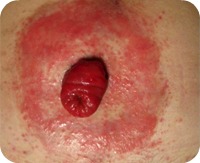 It's Complicated! Ostomy Patients and Peristomal Skin | WCEI