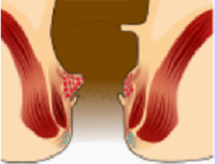 치핵 (hemorrhoid)