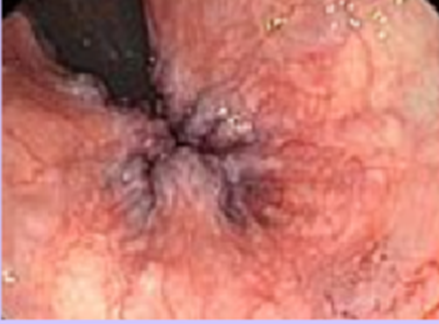 치핵 (hemorrhoid)