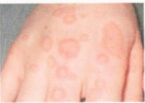 Stevens-Johnson syndrome (SJS) / Toxic Epidermal Necrolysis (TEN)